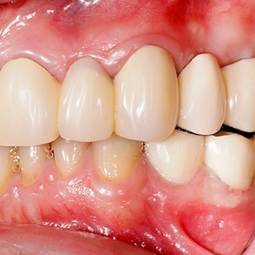 Dental caries and plaque image of teeth