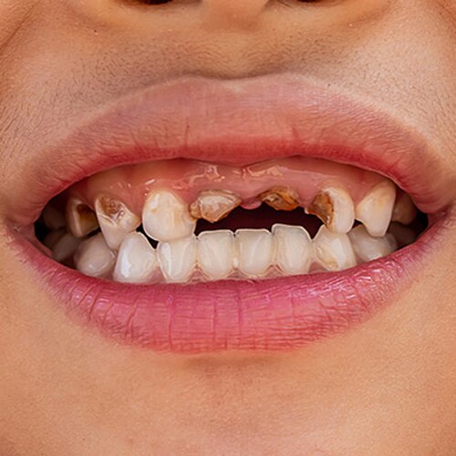 Dental caries and plaque image of teeth