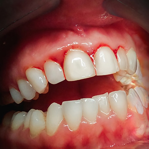 Dental caries and plaque image of teeth