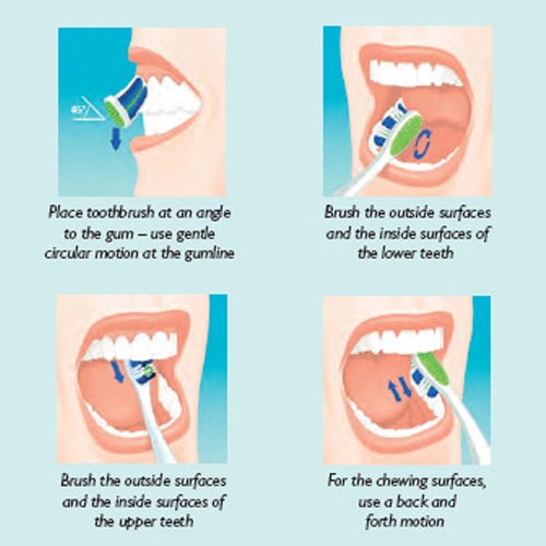 Preventing tooth decay