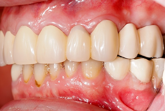 Dental caries and plaque image of teeth