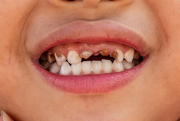 Dental caries and plaque image of teeth