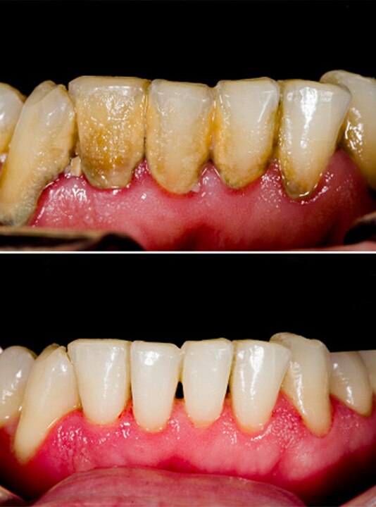 Dental caries and plaque image of teeth