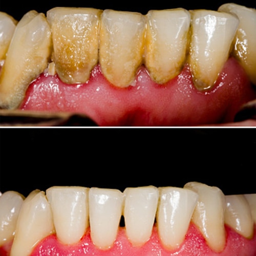 Dental caries and plaque image of teeth